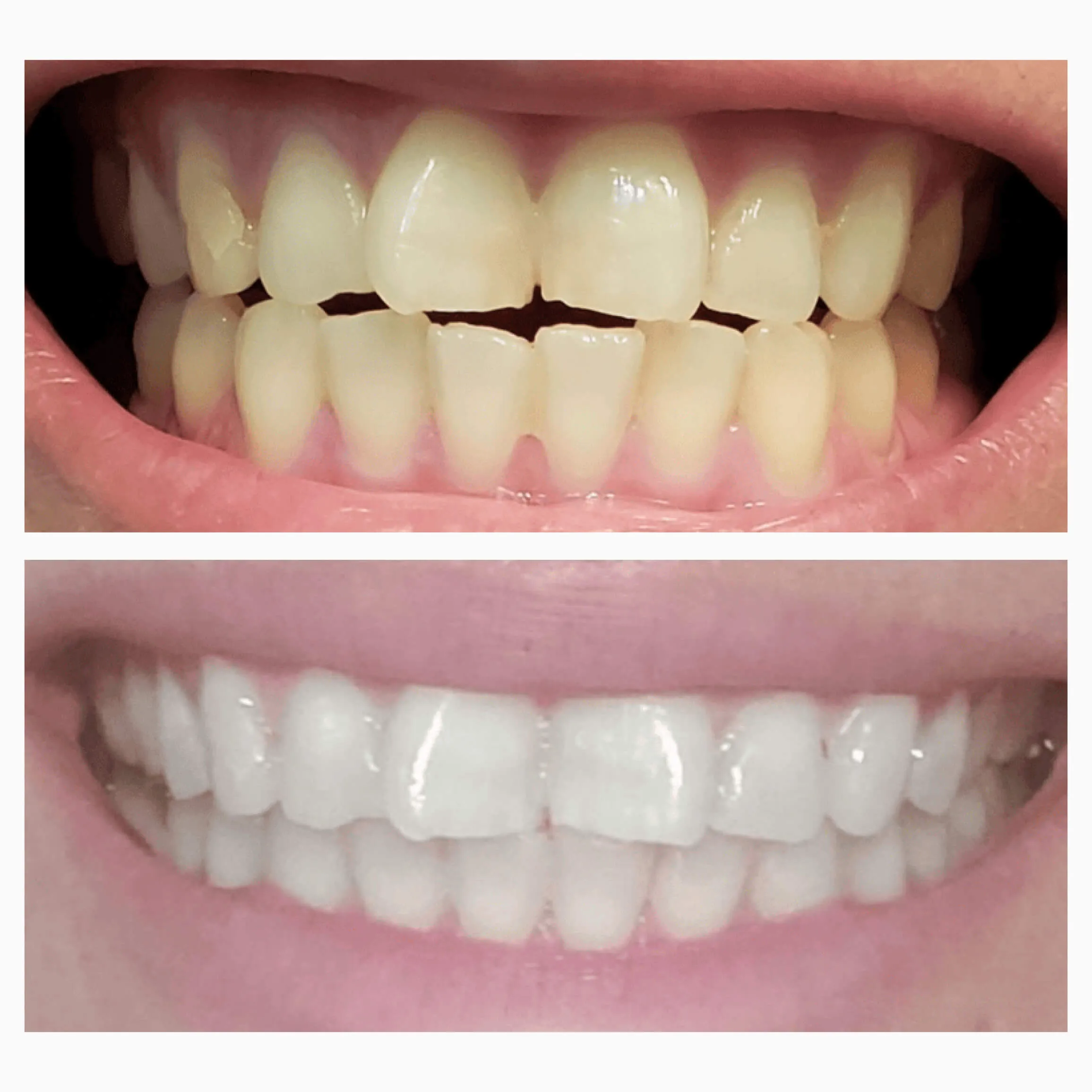 Brighten   Whiten Extra Strength Bundle